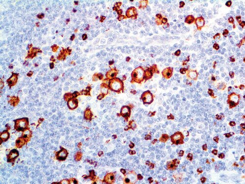 IHC of CD15 on an FFPE Hodgkin’s Lymphoma Tissue